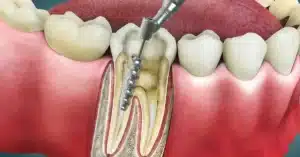 Kanal Tedavisi Fiyatları