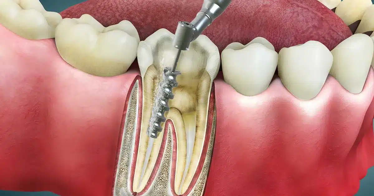 Kanal Tedavisi Fiyatları